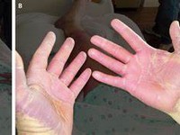Cytarabine.JPG